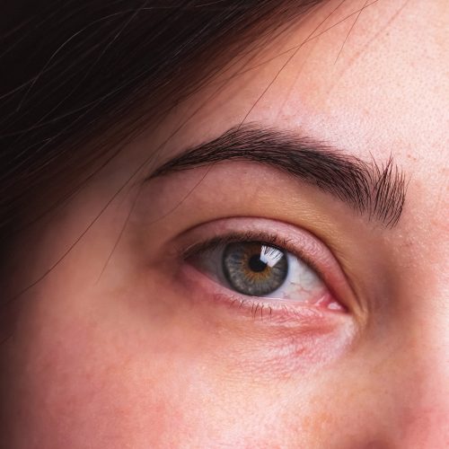 Transplante de Pelos Faciais